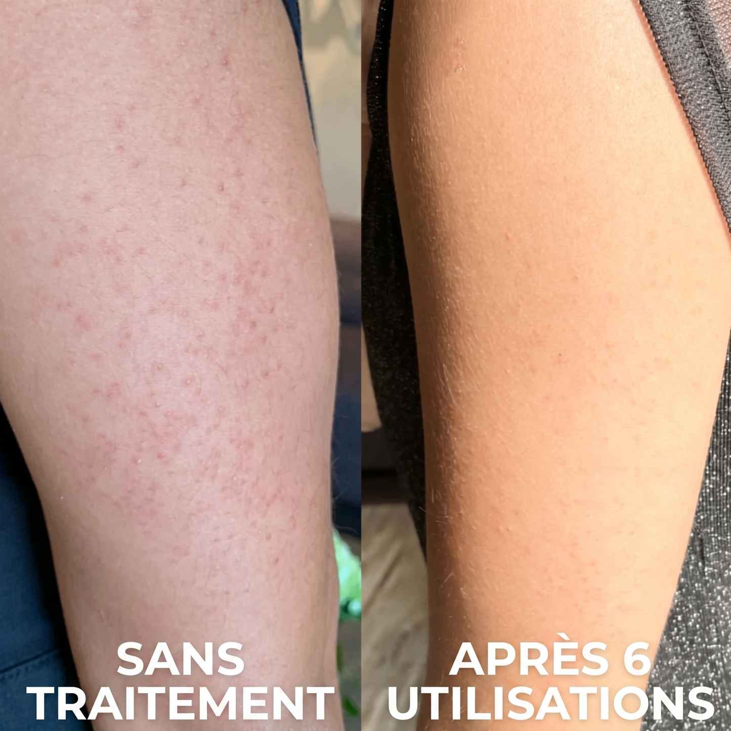 Crème Complexe Triple Acide contre la kératose