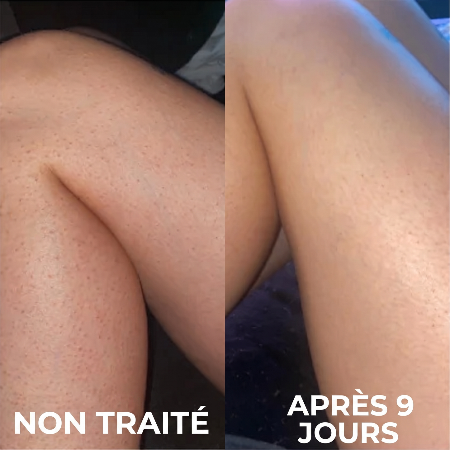 Crème Complexe Triple Acide contre la kératose