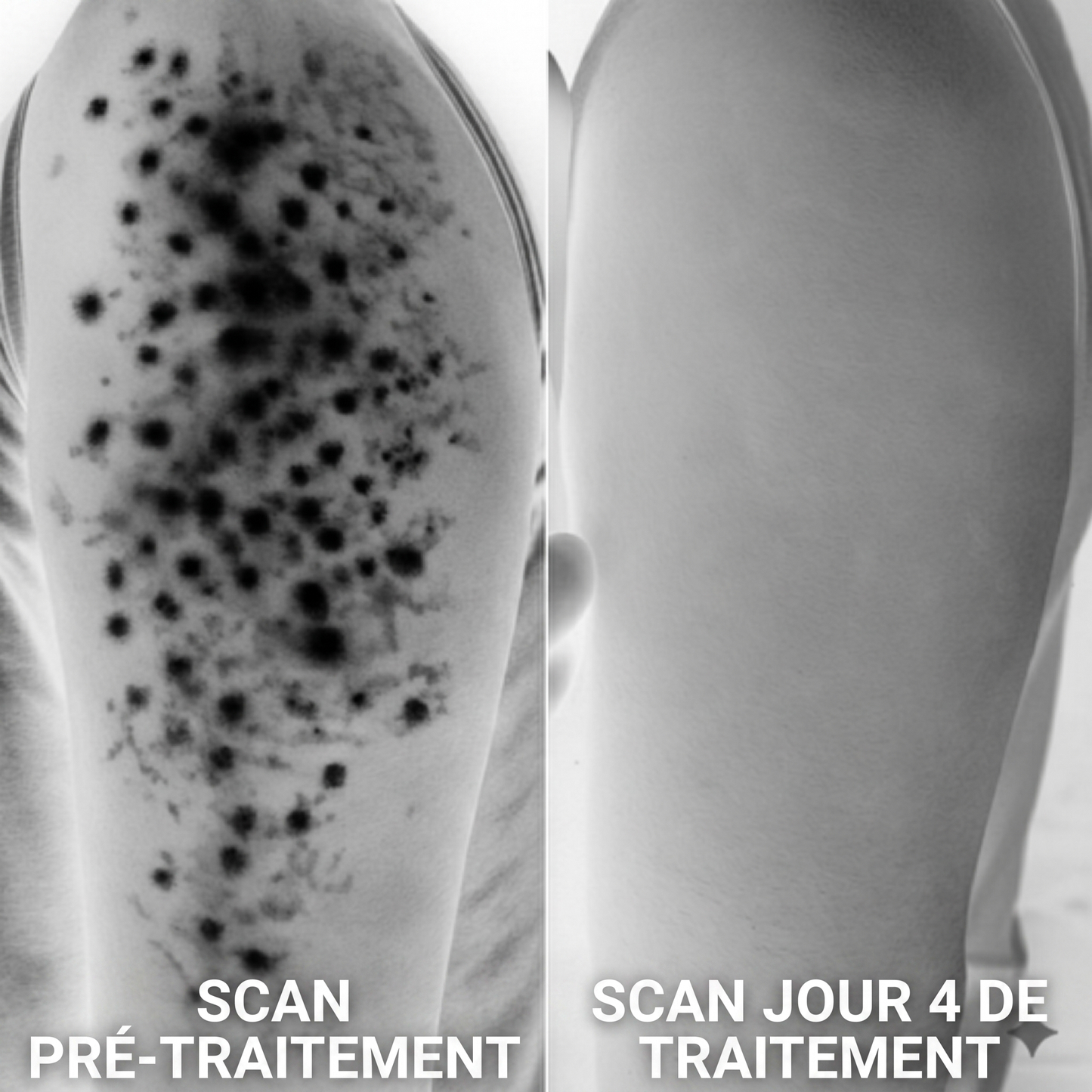 Crème Complexe Triple Acide contre la kératose