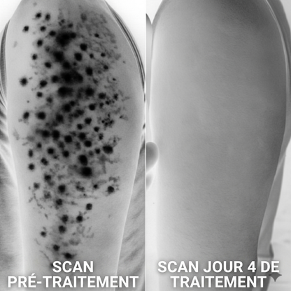 Crème Complexe Triple Acide contre la kératose