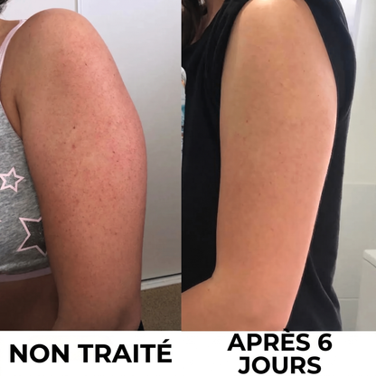 Crème Complexe Triple Acide contre la kératose