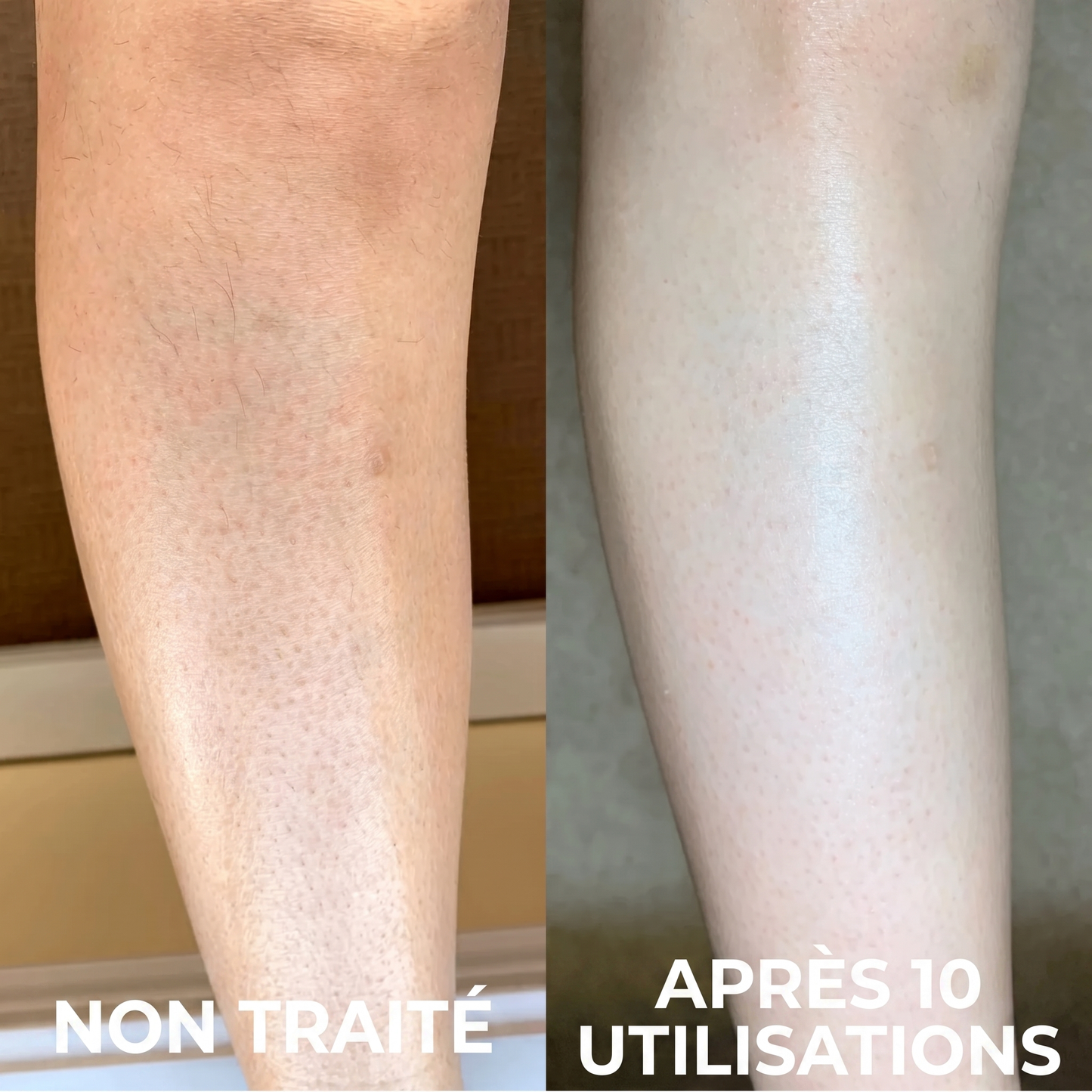 Crème Complexe Triple Acide contre la kératose