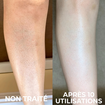 Crème Complexe Triple Acide contre la kératose